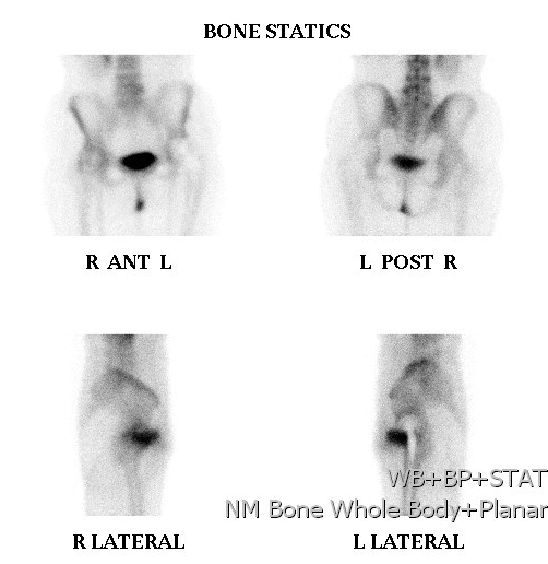Bone Scan Static Bone Images